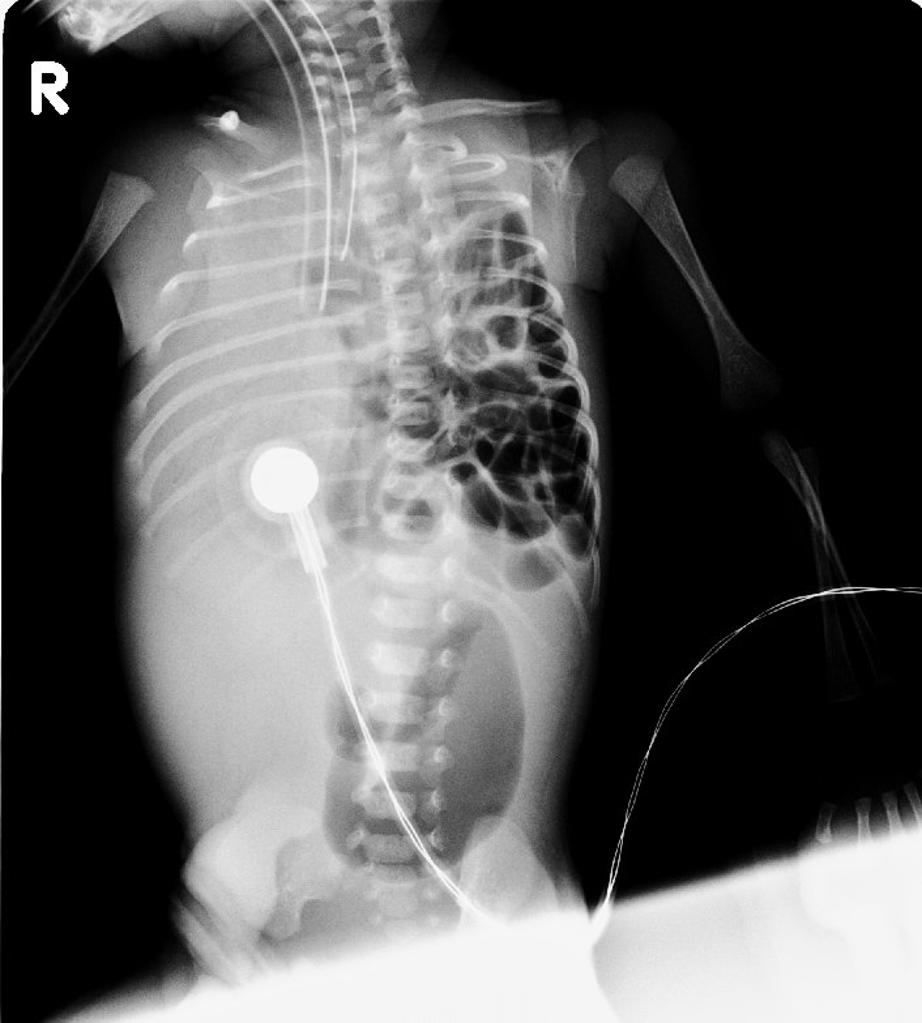 File:Congenital-diaphragmatic-hernia-2.jpg