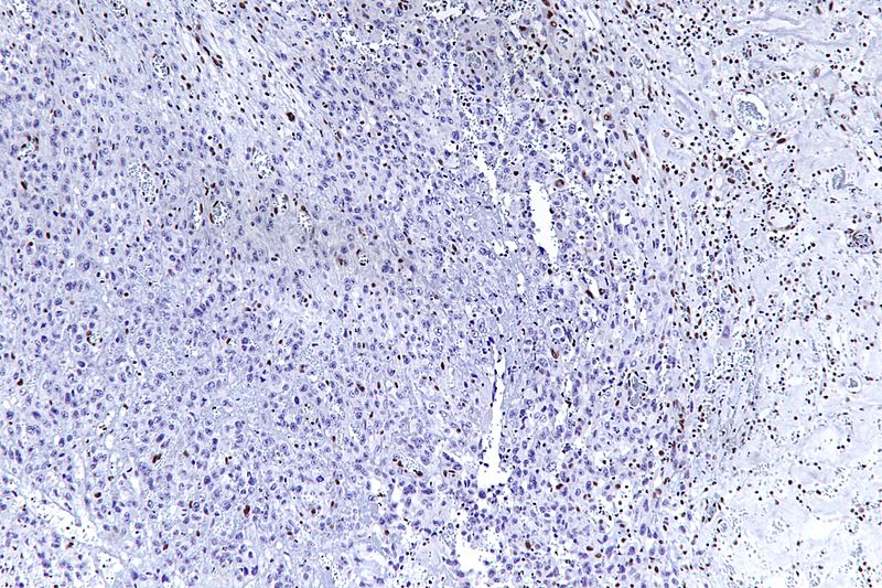 High magnification micrograph of epithelioid sarcoma<ref> Epithelioid sarcoma librepathology