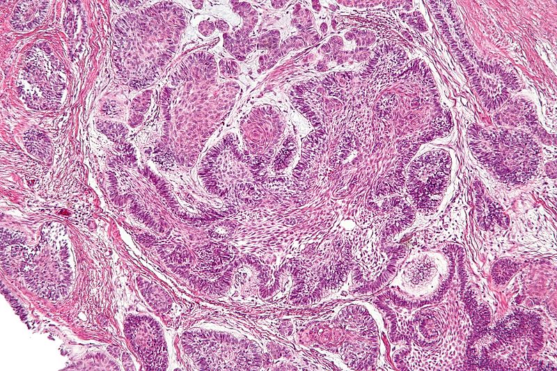 intermediate magnification showing ameloblastoma