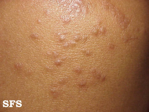 File:Atypical scabies 02.jpeg