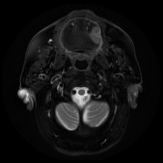 Axial T2 fat saturated MRI of squamous cell carcinoma of tongue[2]
