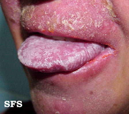 Candidiasis chronic mucocutaneos. Adapted from Dermatology Atlas.[4]