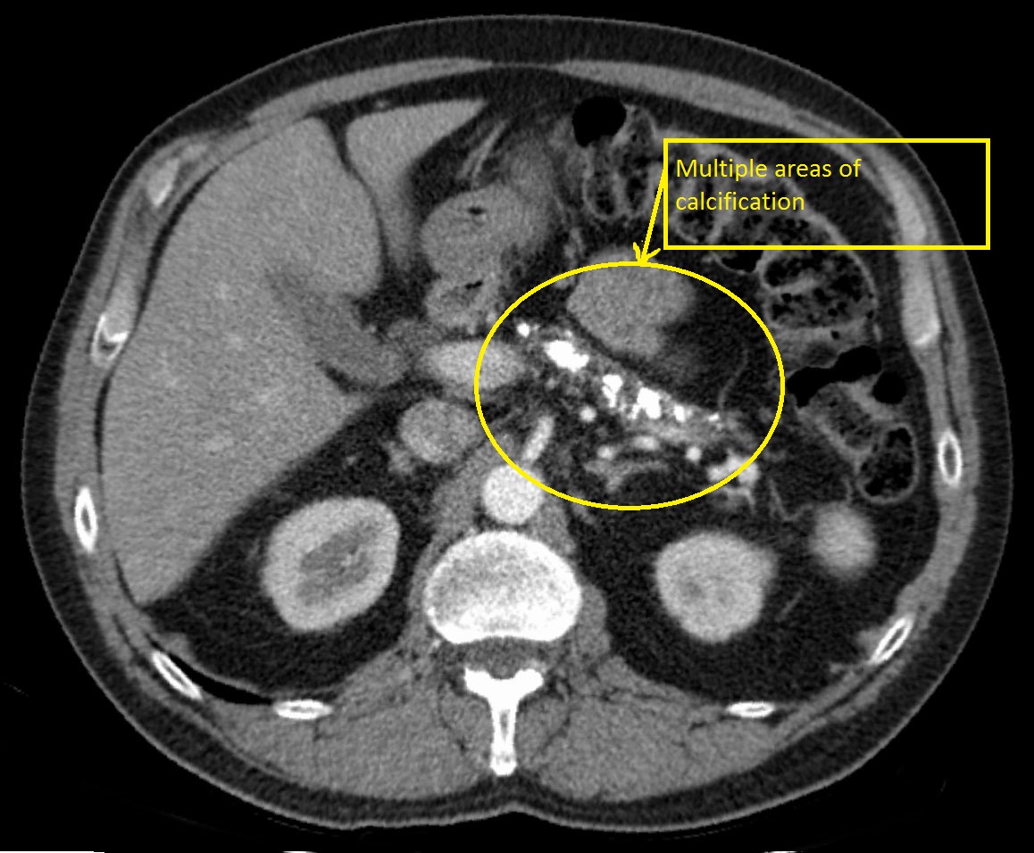 File:Chronische Pankreatitis mit Verkalkungen - CT axial.jpg