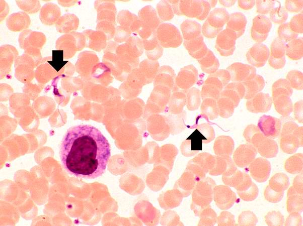 This peripheral blood smear from the patient shows two trypomastigotes of Trypanosoma cruzi.