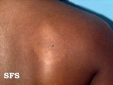 Indeterminate leprosr. Adapted from Dermatology Atlas.<ref name="Dermatology Atlas">{{Cite