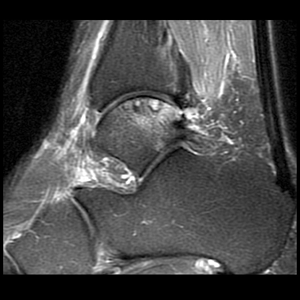 File:Subchondral-fracture-talar-dome (1).jpg