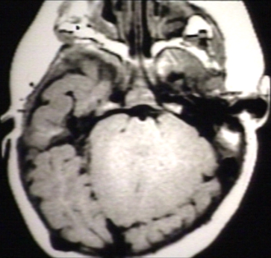 Brain: Arnold Chiari II, with Cerebellar Hemispheres that Creep Anteriorly Around the Brain Stem; T1 (MRI)