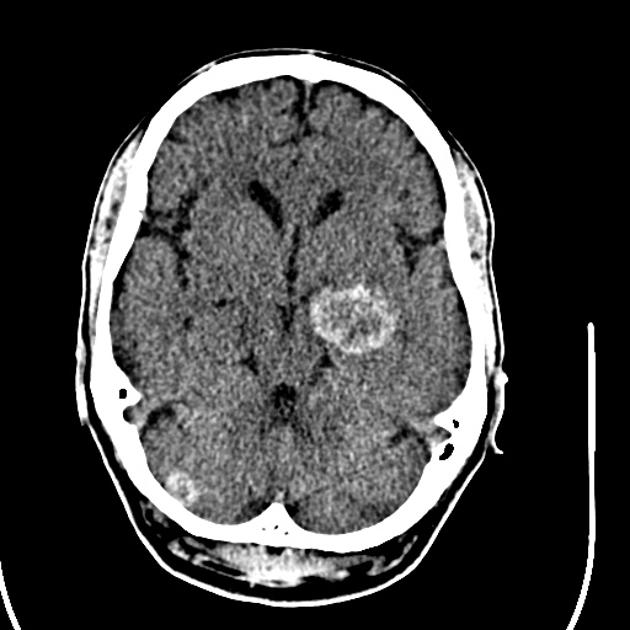 Noncontrast CT scan of a 53 year old caucasian male with known history of malignant melanoma, complaining of headaches, demonstrates hyperdense lesions in brain.[9]
