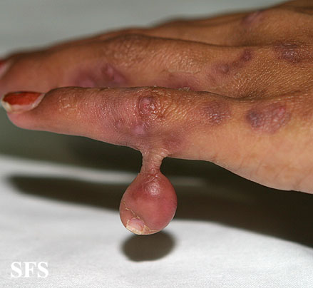 Rudimentary polydactyly. Adapted from Dermatology Atlas.[2]