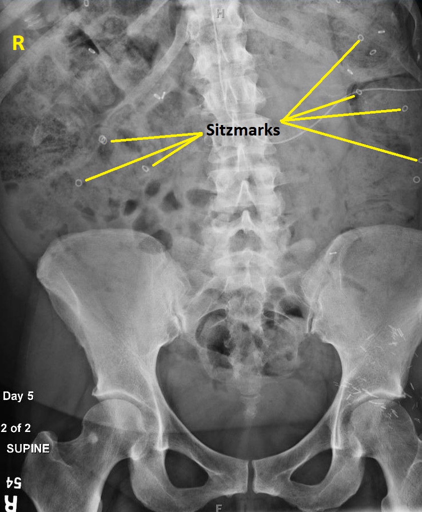 Constipation abdominal x ray - wikidoc