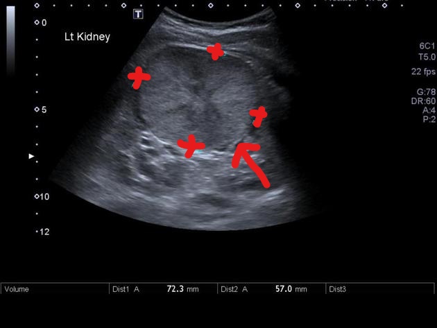 File:Inkedrenal oncocytoma ultrasound LI.jpg