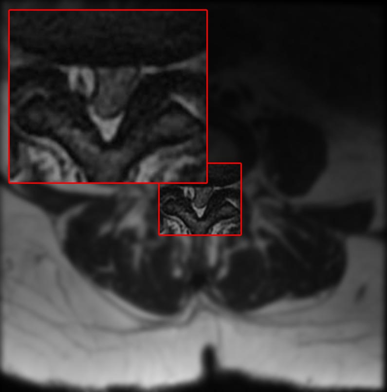 File:Intraspinal synovial cyst 004.jpg