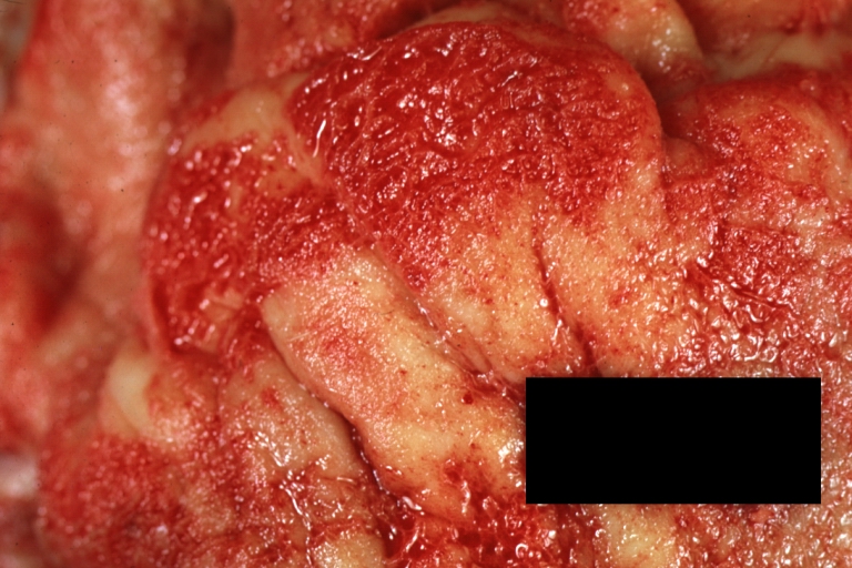 Fibrinous pericarditis: Gross, a close-up view, an excellent illustration of fibrinous exudate.