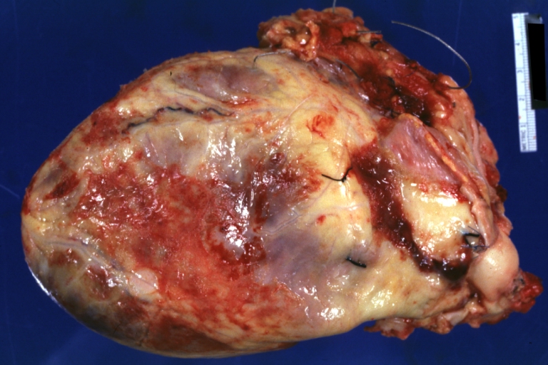 Heart transplant: Gross, natural color, external view of heart. Two months after transplantation with fibrinous pericarditis.
