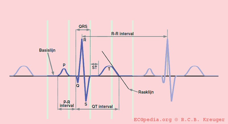 The QT interval start at the onset of the Q wave and ends where the tangent line for the steepest part of the T wave intersects with the baseline of the ECG.