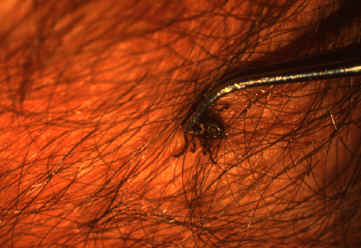 Removal of an embedded tick using fine-tipped tweezers