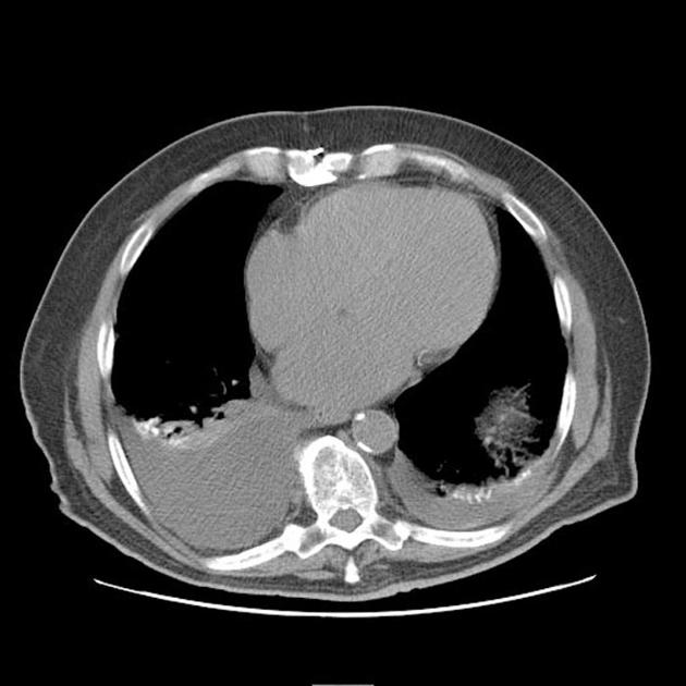 File:Axial CT aspiration.jpg
