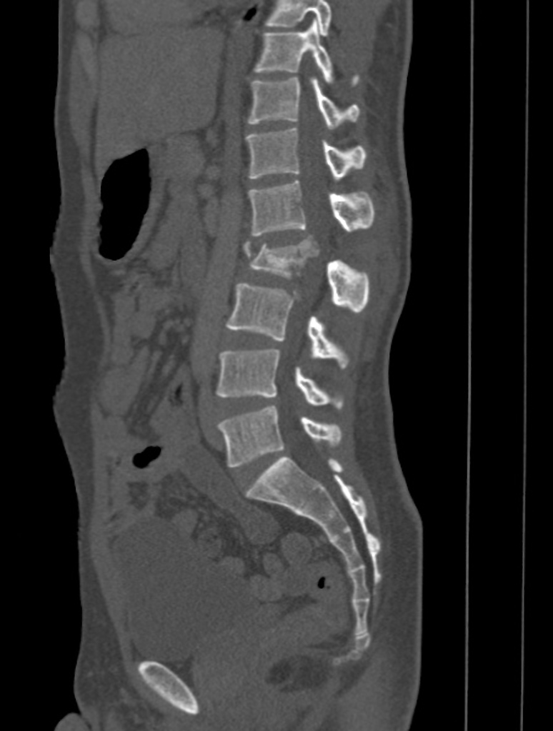 CT spine.gif.gif