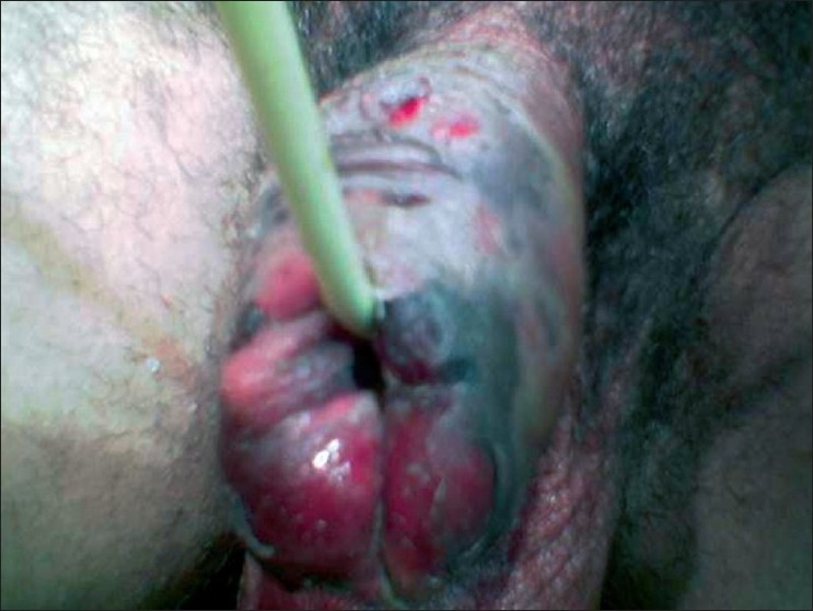 Discolouration of the penis with vesicles filled with hemorrhagic fluid.[33]