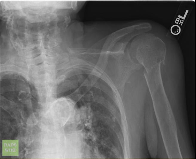 File:Humeral-neck-fracture-002.jpg