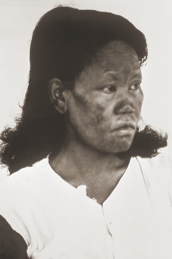 Lepromatous or multibacillary leprosy. Note wrinkling of the face, especially the midface involving nose and cheeks, and around the eyes. Adapted from Public Health Image Library (PHIL), Centers for Disease Control and Prevention.[5]