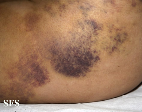File:Painful bruising syndrome06.jpg