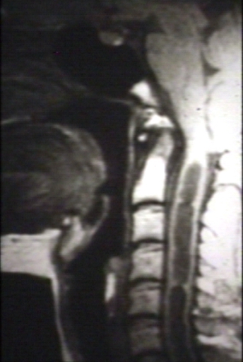 Brain: Arnold Chiari I, with Hydromyelia of Cervical Spinal Cord; T1 (MRI)