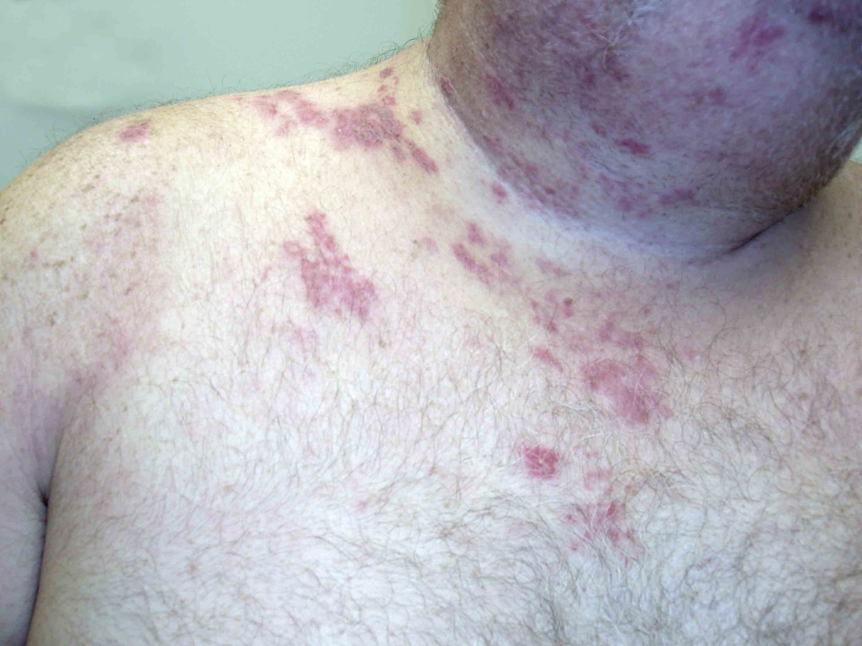 Herpes Zoster C3 Distribution: Dermatomally distributed vesicles, many of which have coalesced, in patient with HZV infection.