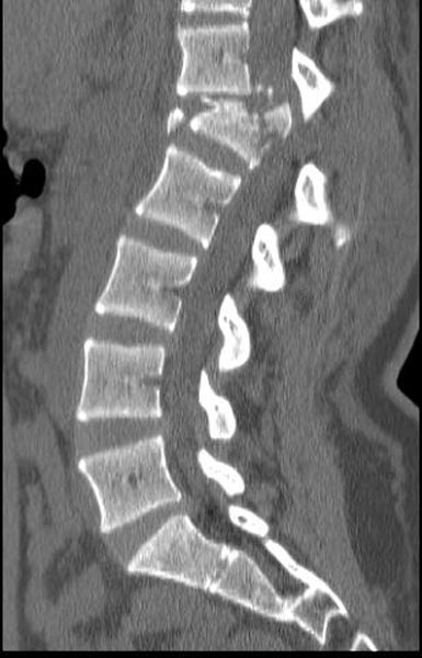 File:Chance-fracture-001.jpg