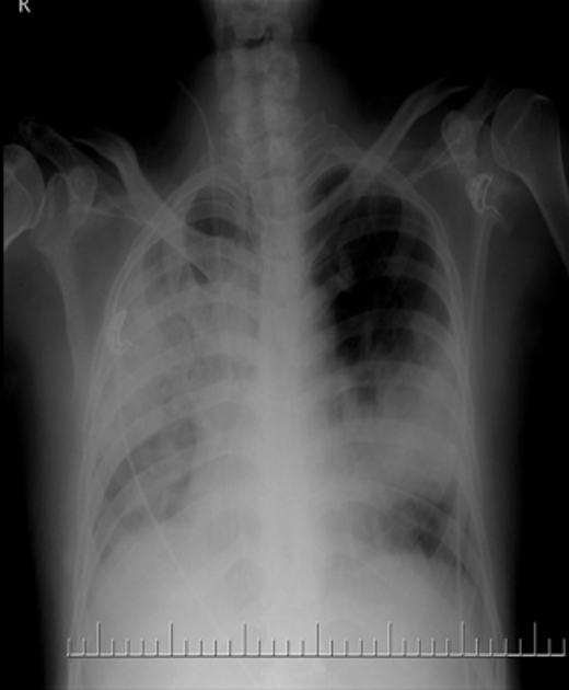 X-ray shows homogenous radio-opaque areas in bilateral lung fields. These represent areas of consolidation. Image courtesy of Dr Aditya Shetty, Radiopedia. (original file here). Creative Commons BY-SA-NC