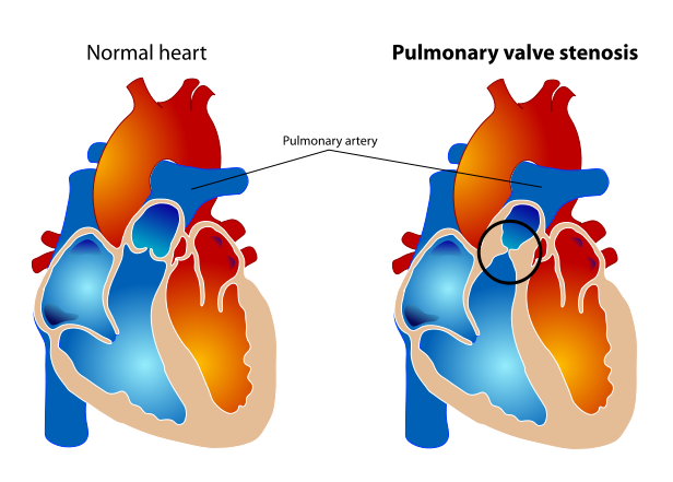 Pulmonary valve stenosis.svg