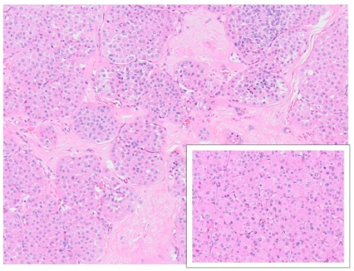 File:Renal oncocytoma.png