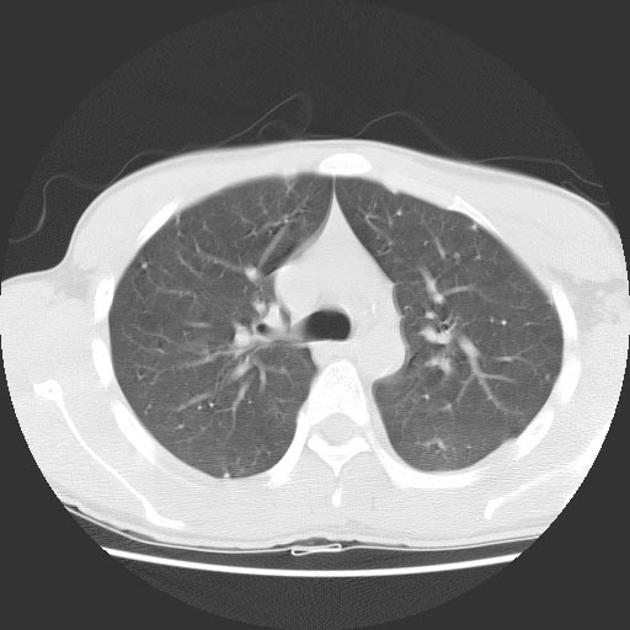High attenuation nodules observed in both lungs.[2]
