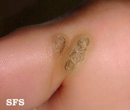 Warts plantaris. Adapted from Dermatology Atlas.[1]
