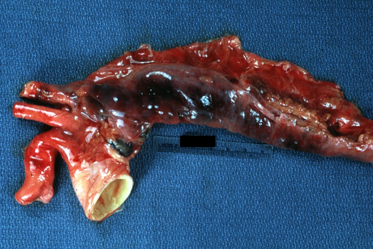 Dissecting Aneurysm: Gross external view good appearance from adventitia