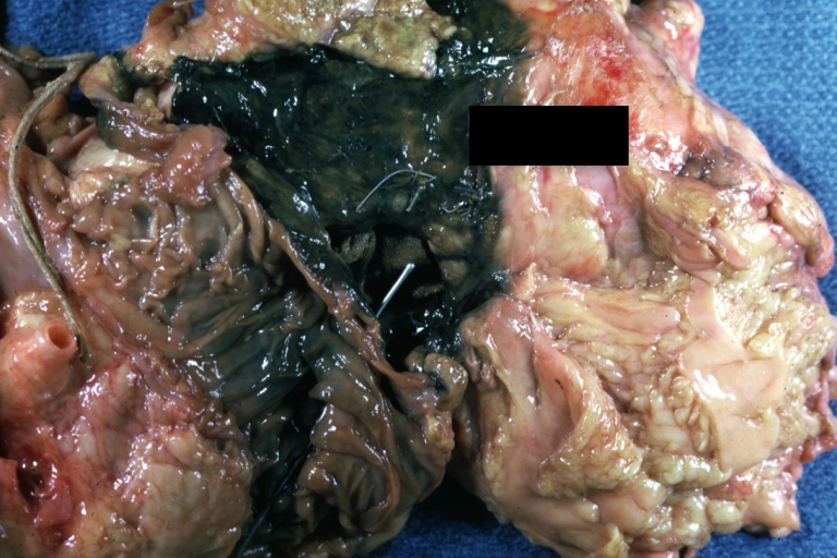 Atherosclerotic Aneurysm Infected: Gross, infected abdominal aneurysm at superior suture line with rupture into duodenum