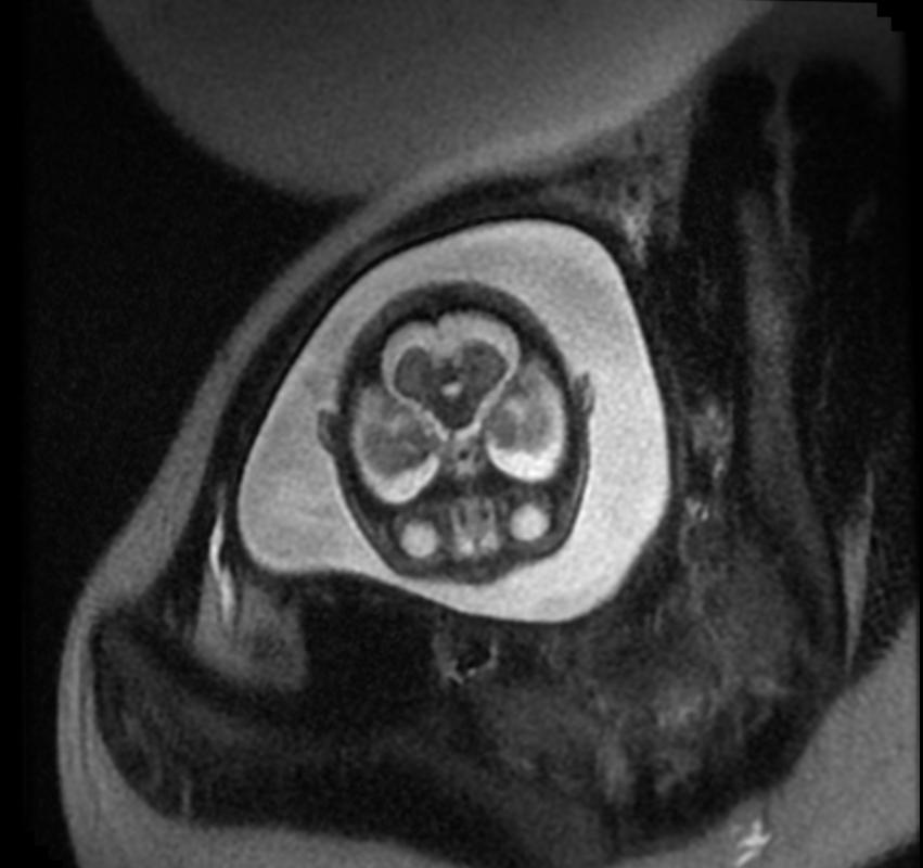 File:Aqueductal stenosis fetal MRI 001.jpg