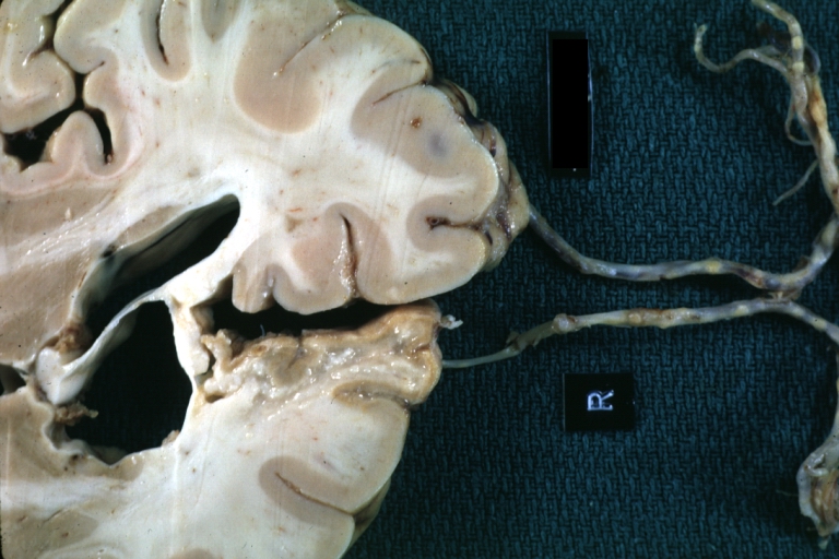 Brain: Old Cystic Encephalomalacia: Gross, fixed tissue, frontal lobe lesion with frontal artery atherosclerosis