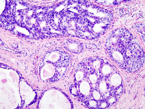 Histopathologic image from ductal cell carcinoma in situ (DCIS) of breast. Hematoxylin-eosin stain.