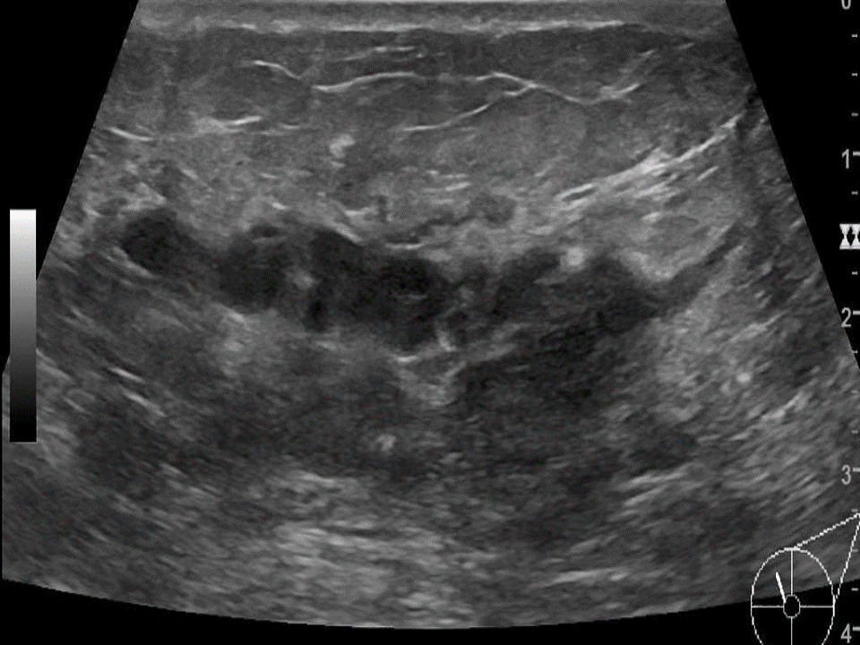 Breast Lumps Ultrasound Wikidoc