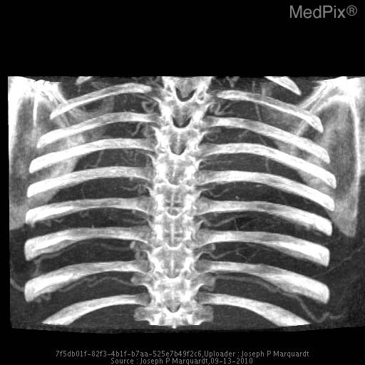 File:CT Angiography Enlarged Inrercoastal Arteries.jpg