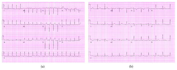 File:First-degree heart block and complete heart block.jpg