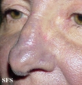 Hyperpigmentation Due To Amiodarone. With permission of Dermatology Atlas