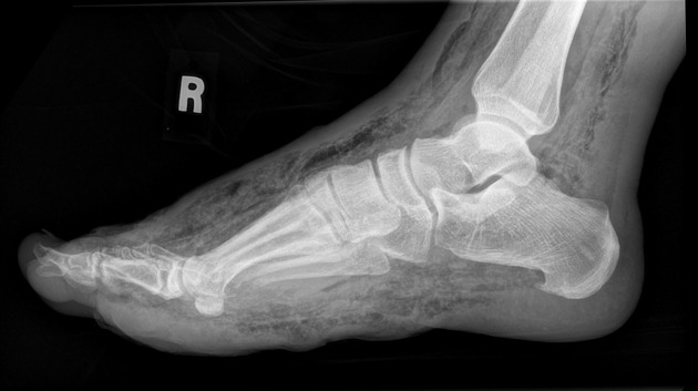 X ray (Nerotizing fasciitis of diabetic foot)[2]