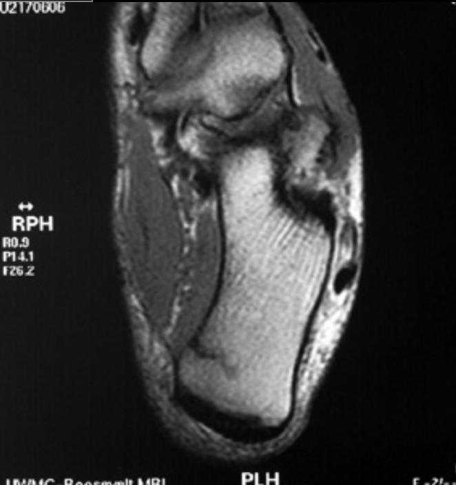 File:Stress-fracture-103.jpg