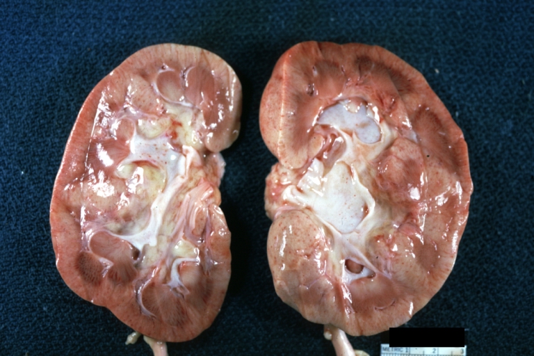 Kidney: Lupus erythematosus: Gross cut surface pale kidneys typical of nephrotic syndrome (subacute glomerulonephritis)