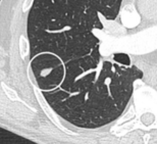File:Perifissural solitary pulmonary nodules.png