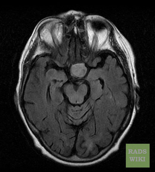 There is a well defined round lesion noted in the pituitary fossa, the lesion is slightly hyperintense on axial FLAIR.[7]