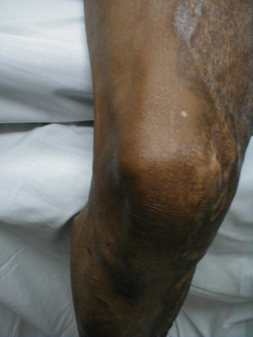 Gout of the Knee: Image demonstrates redness and swelling caused by acute gouty arthritis.