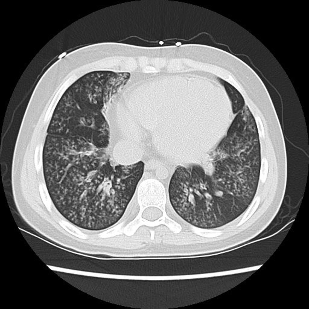 File:Infectious-bronchiolitis-with-extensive-tree-in-bud-pattern-1.jpg